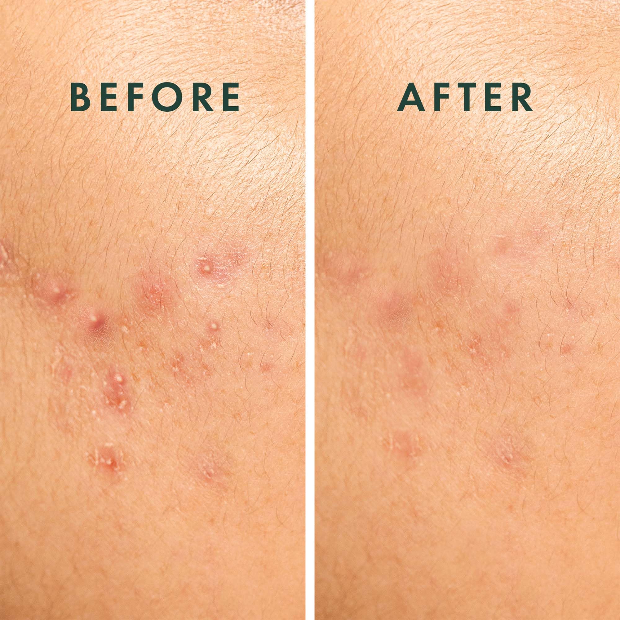 Rael Miracle Spot Control Cover Hydrocolloid Strips Pimple - Rael