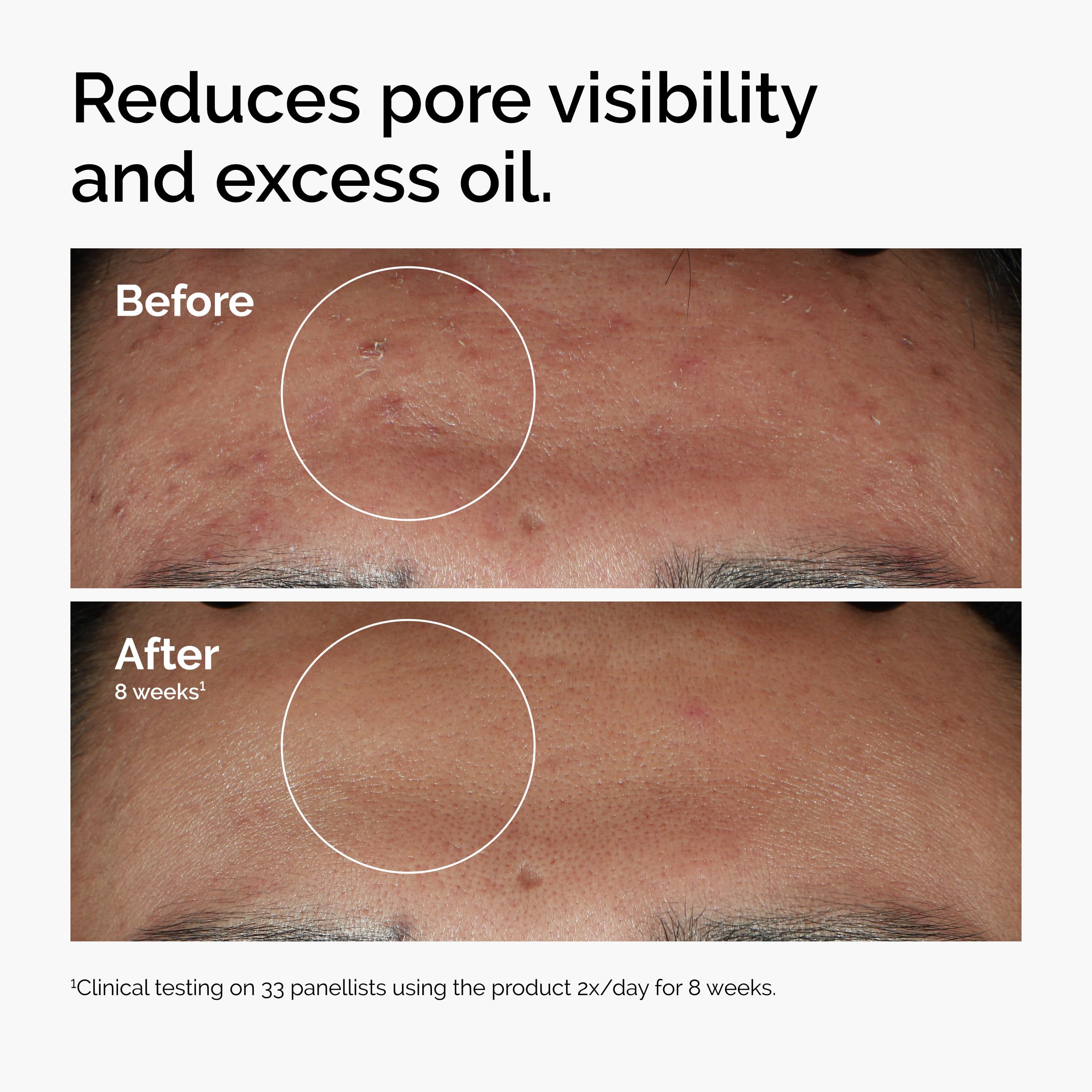 The Ordinary Niacinamide 10% + Zinc 1%, Smoothing Serum for Bl... - Elefair Tech Official Product View 3