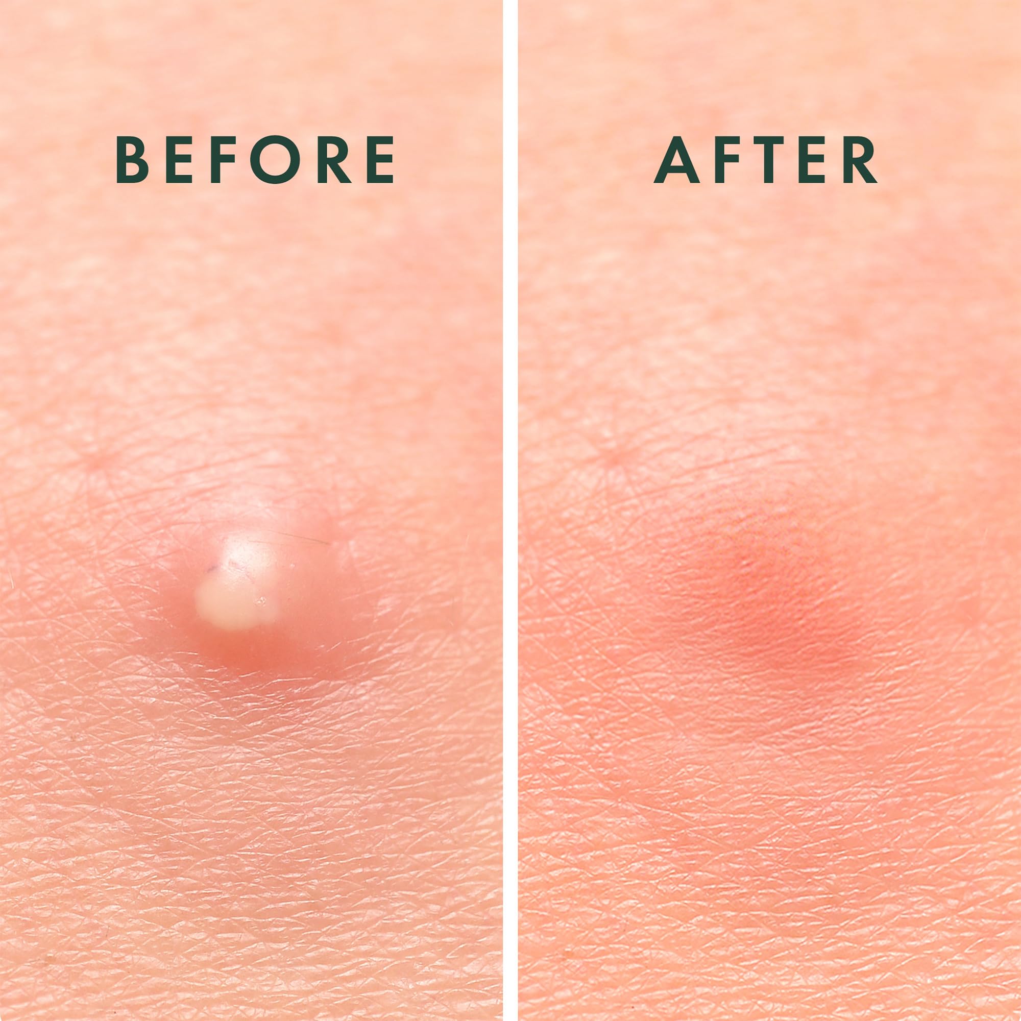 Rael Miracle Hydrocolloid Acne Pimple Patches in a 96-count pack, showing clear patches designed to treat blemishes.