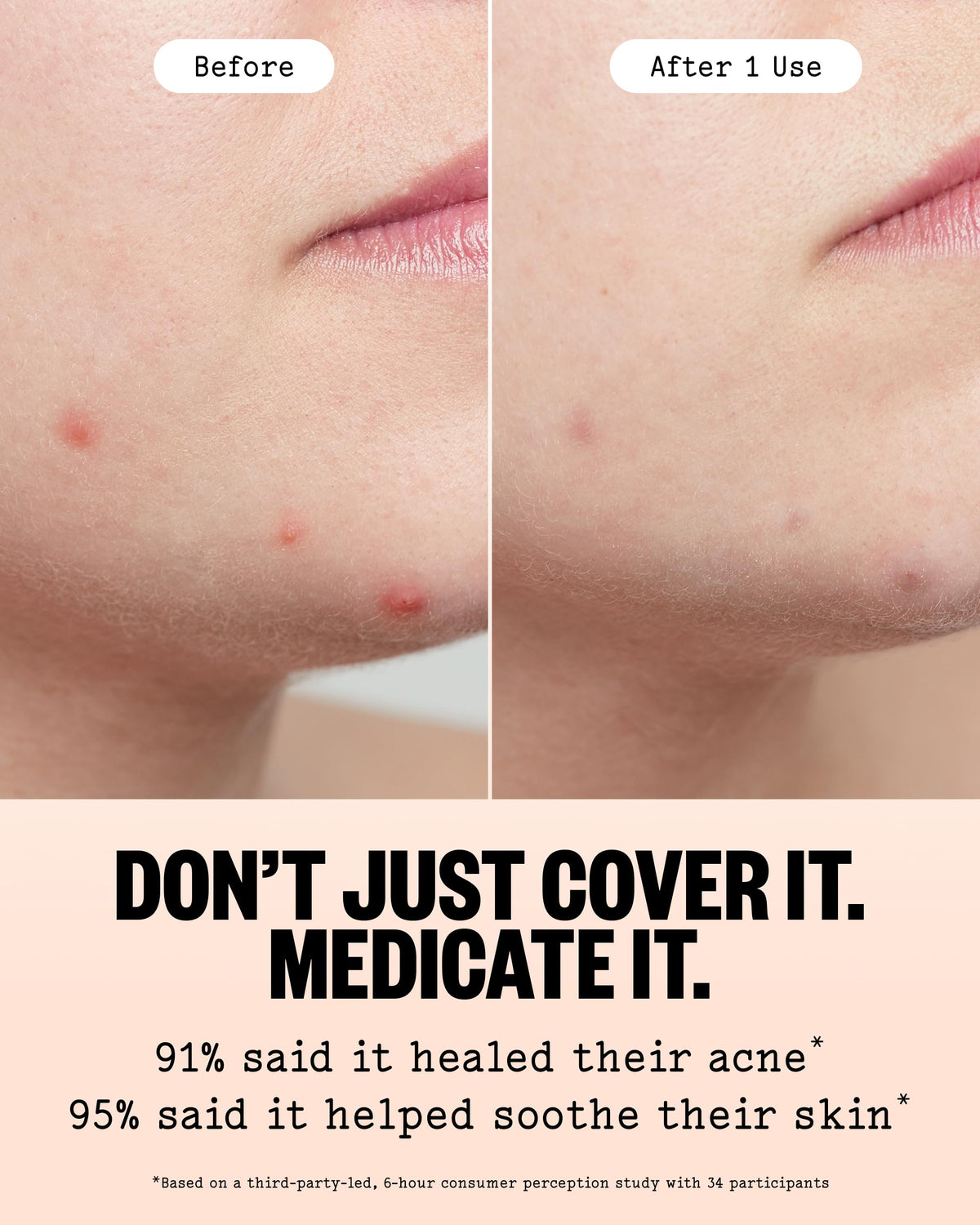 PEACE OUT Acne Healing Dots Hydrocolloid Pimple Patches - PEACE OUT Official Imagery - 7