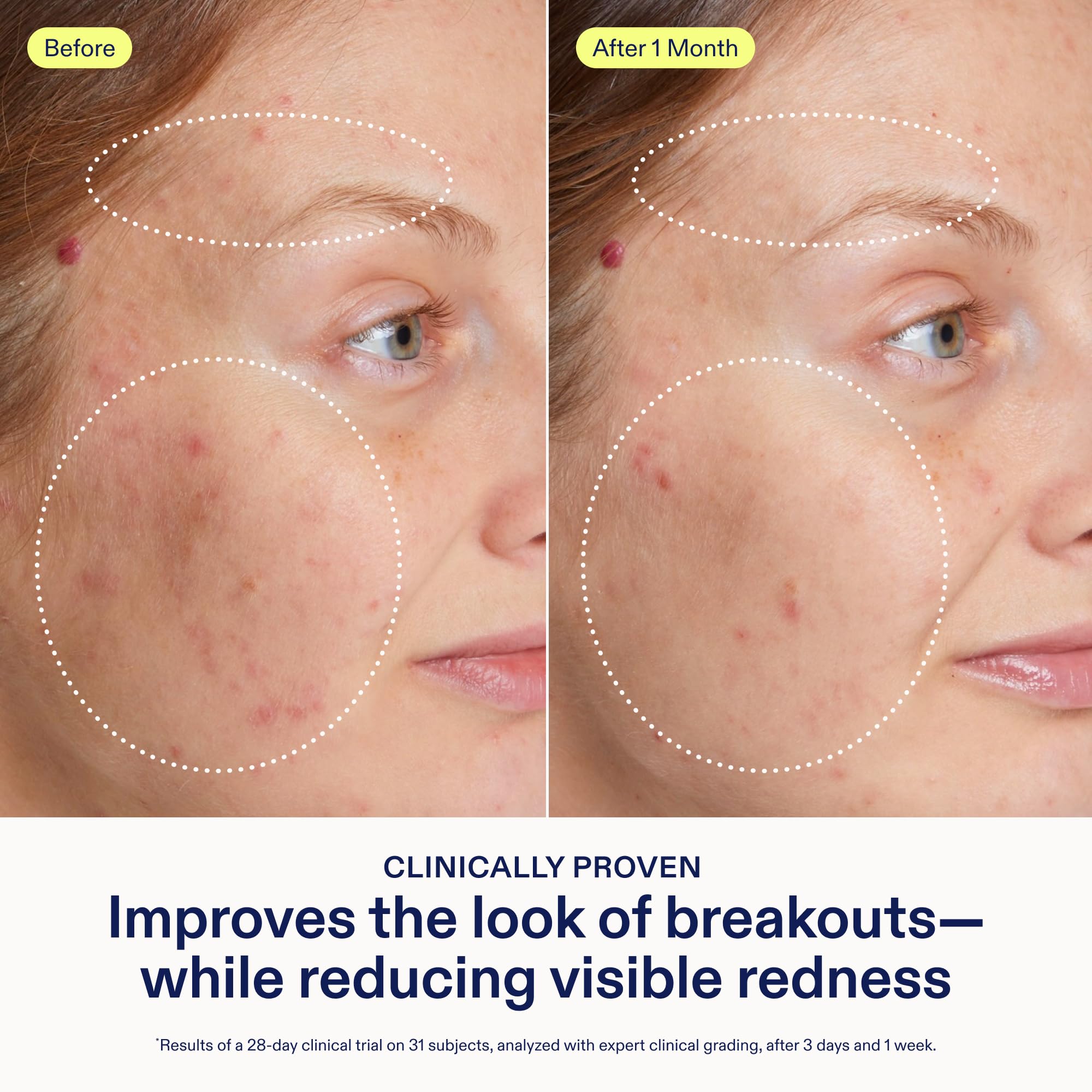 Skinfix Adapinoid Gel - Skinfix Official Imagery - 5