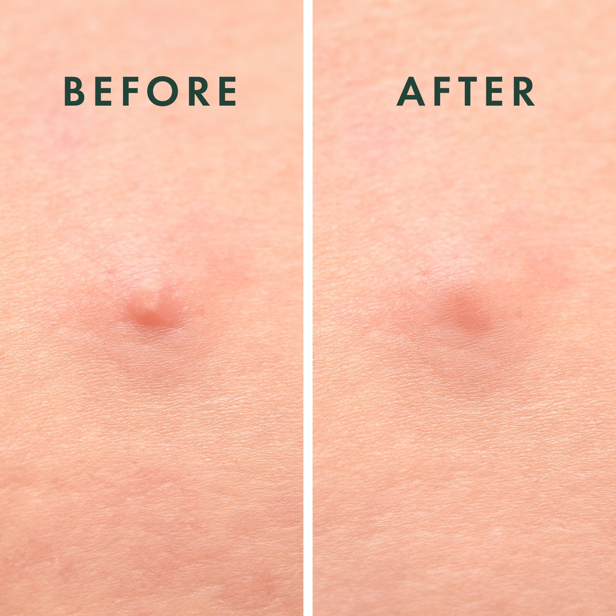 Rael Miracle Microcrystal Spot Cover Hydrocolloid Pimple - Rael Official Imagery - 8