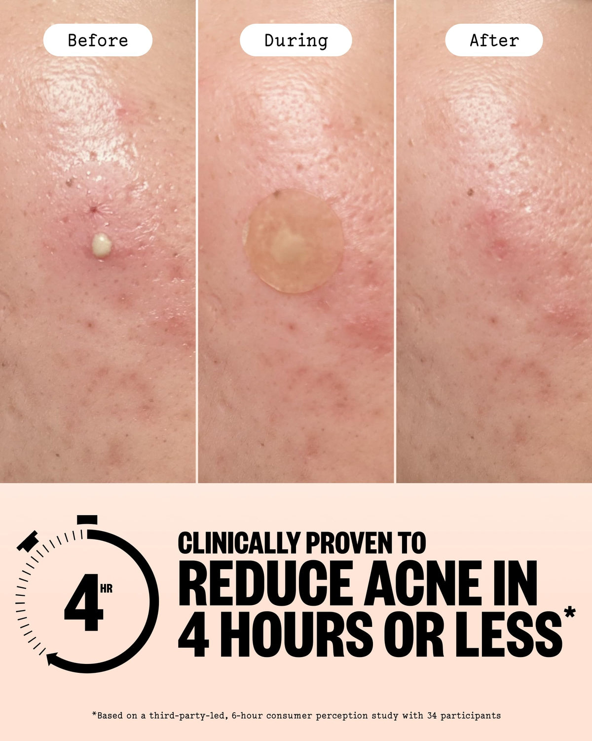 PEACE OUT Acne Healing Dots Hydrocolloid Pimple Patches - PEACE OUT Official Imagery - 4