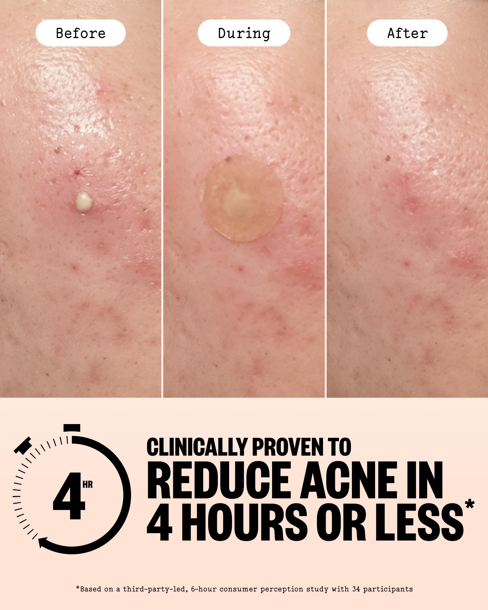 PEACE OUT Acne Day Night Duo Hydrocolloid Pimple Patches - PEACE OUT Official Imagery - 4