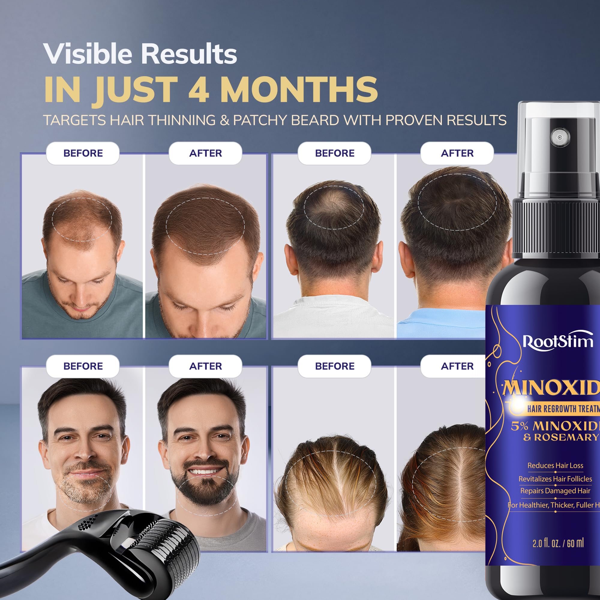 5 Minoxidil Spray 0 25mm Derma Roller Hair Growth Kit for - RootStim Official Imagery - 3