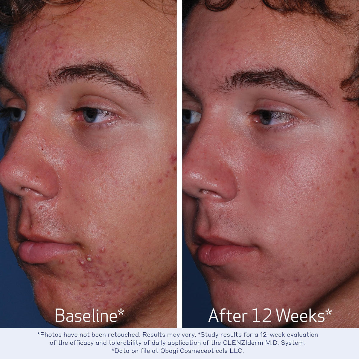 Obagi Medical CLENZIderm M D Pore Therapy Acne Treatment - Premium Selection Official Imagery - 5