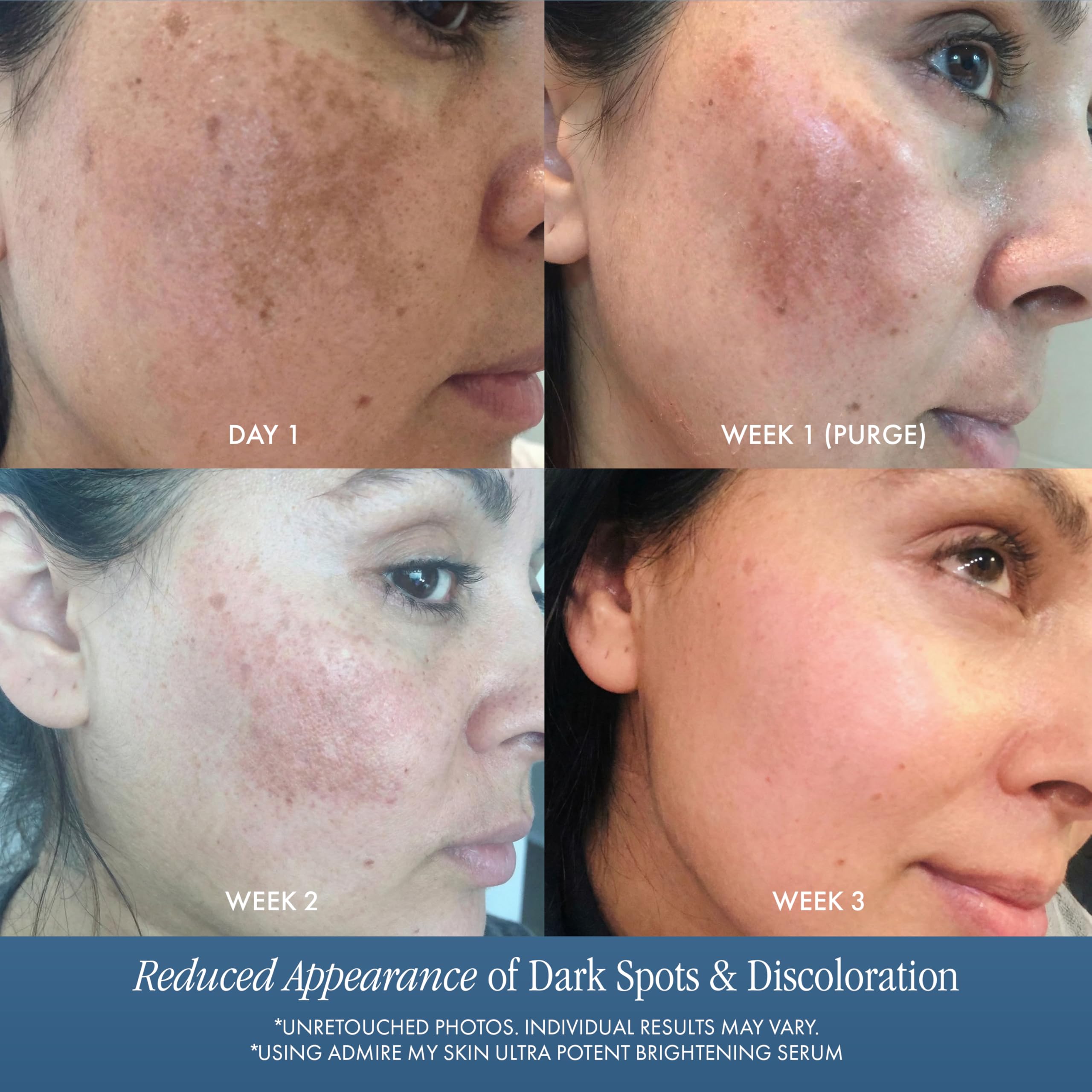 Admire My Skin Dark Spot Corrector Remover for Face Brightening Serum - Admire My Skin Official Product View 6