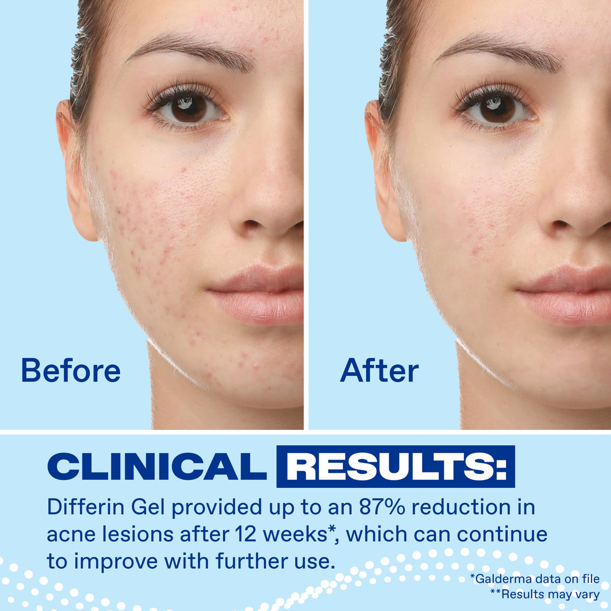 Differin Acne Retinoid Treatment Gel 0 1 Adapalene 45g Tube - Differin Official Imagery - 7