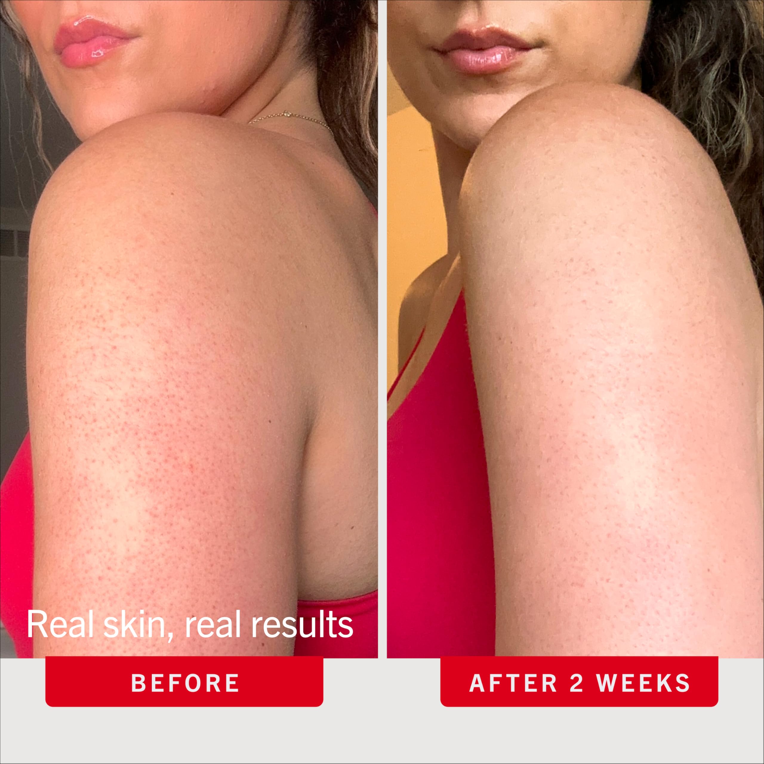 Elefair Tech First Aid Beauty KP Bump Eraser Body Scrub with 10% AHA - - Elefair Tech Official Product View 5