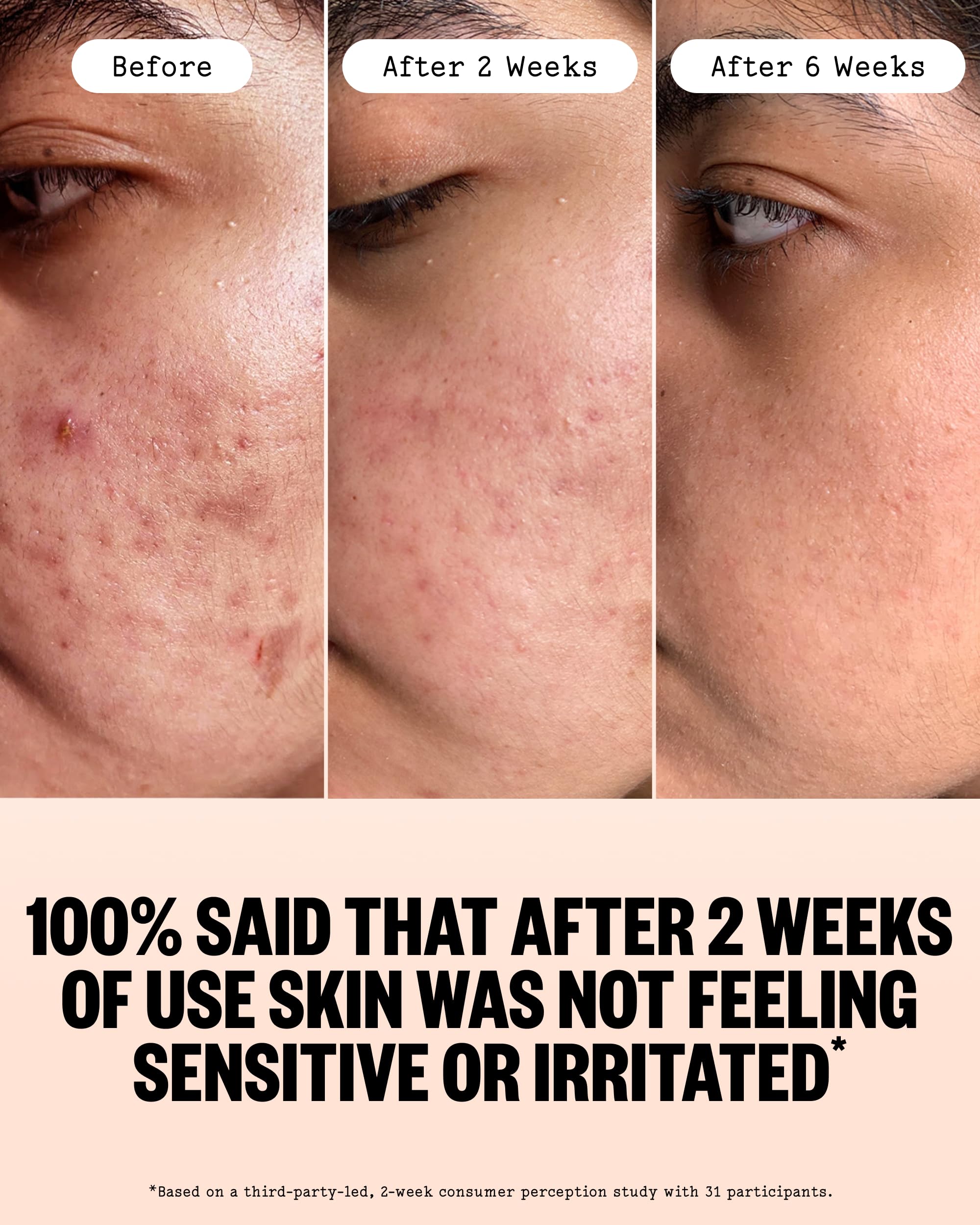 PEACE OUT Acne Face Serum with 2% Salicylic Acid - PEACE OUT Official Product View 4