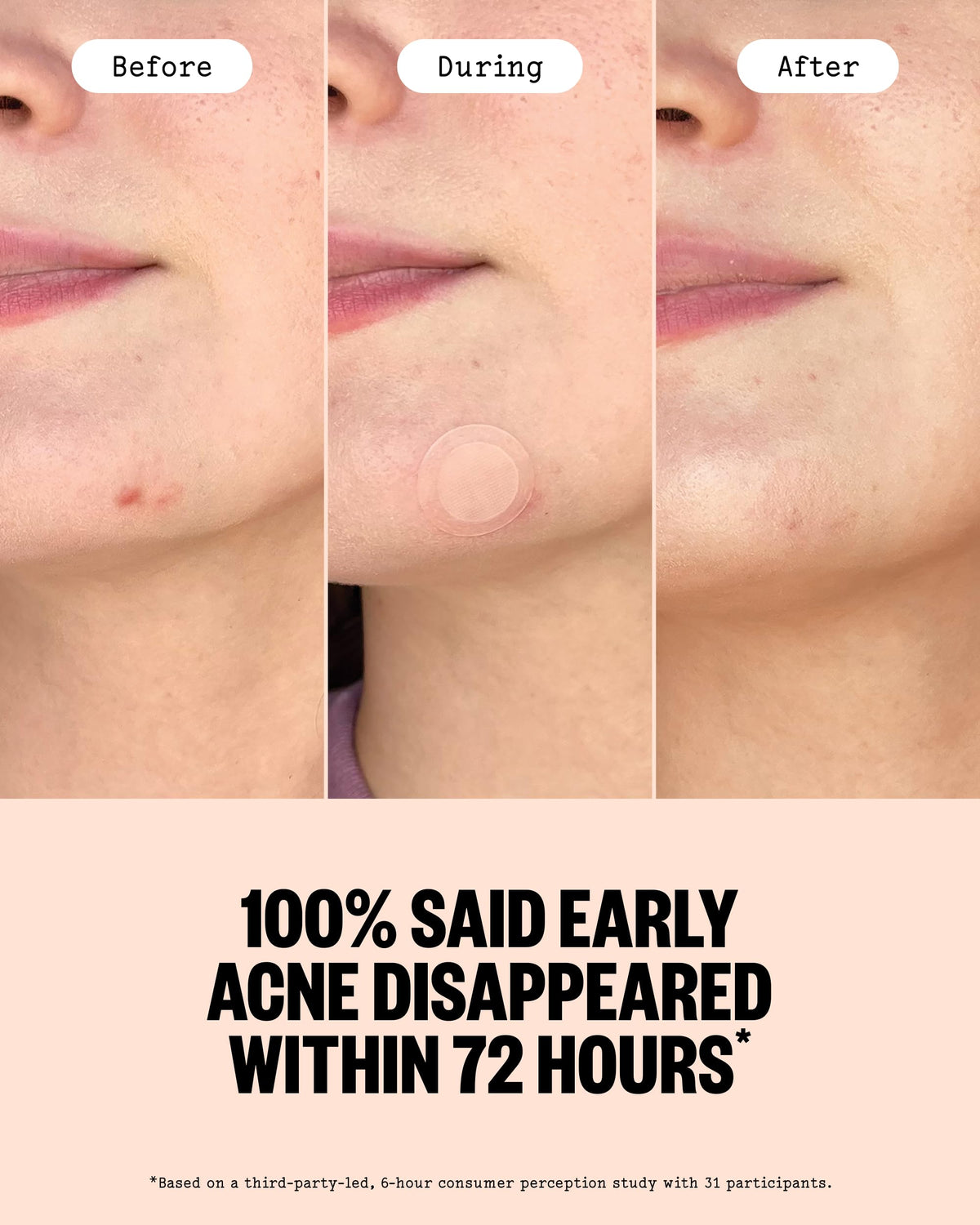 PEACE OUT Early Stage Acne Microneedling Hydrocolloid Dots - PEACE OUT Official Imagery - 6