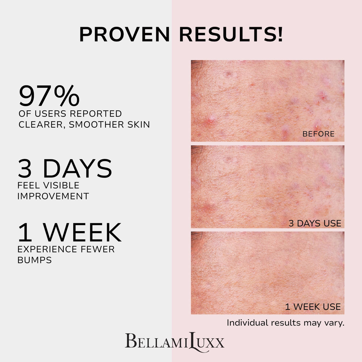 BellamiLuxx Butt Acne Clearing Treatment Cream Body Acne - BellamiLuxx Official Imagery - 3