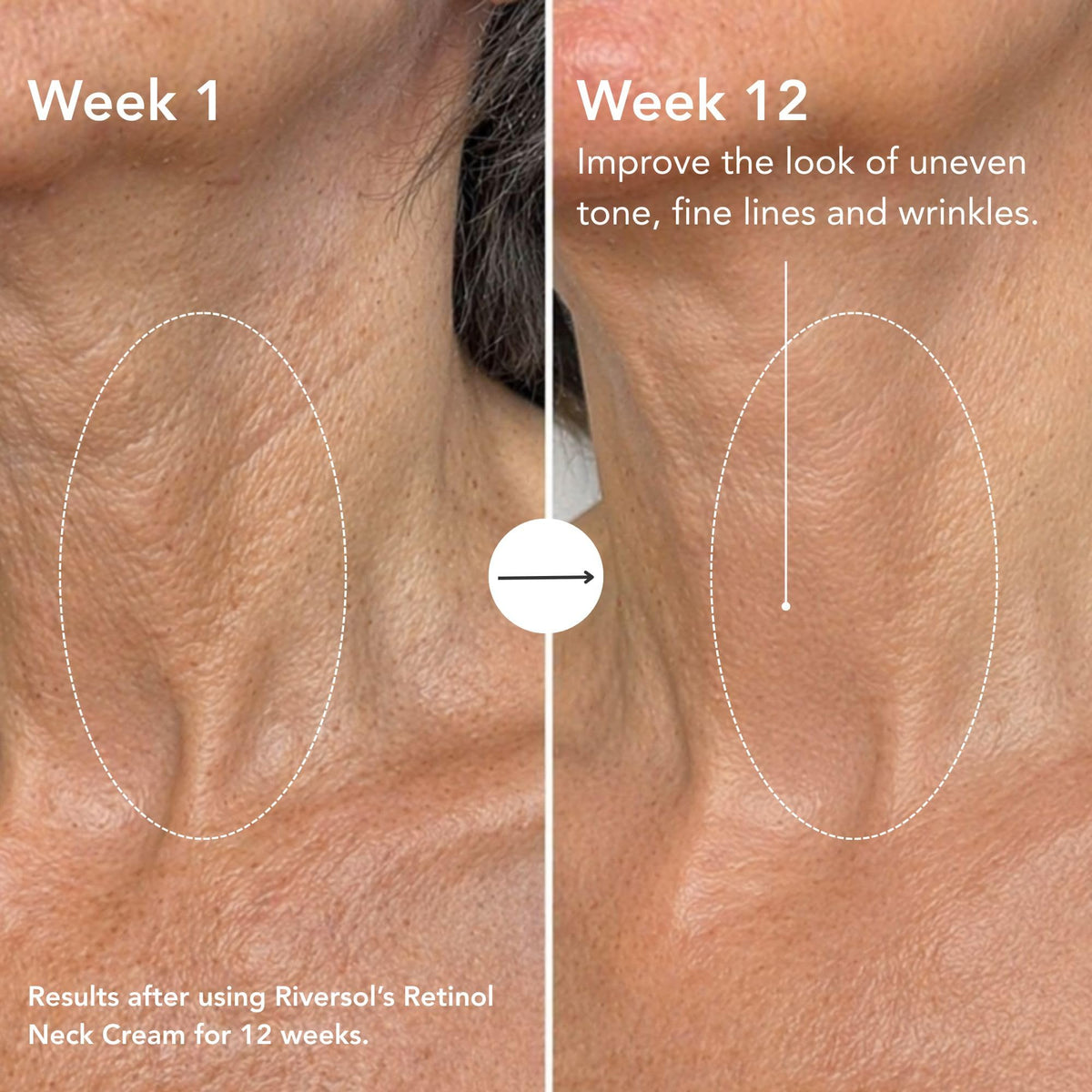Tightening Neck Cream for Aging Skin Turkey Neck - Riversol Official Imagery - 4