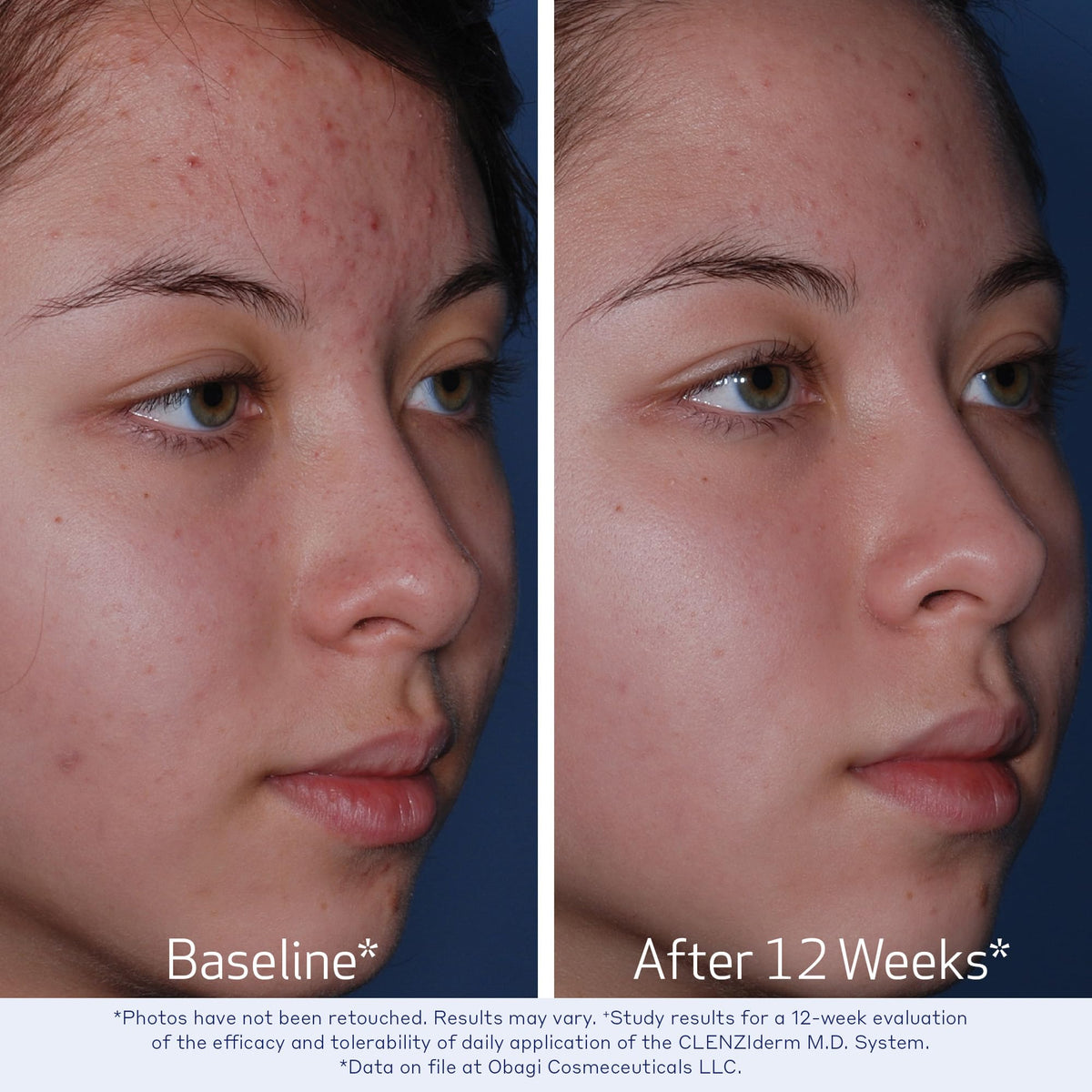 Obagi Medical CLENZIderm M D Pore Therapy Acne Treatment - Premium Selection Official Imagery - 4