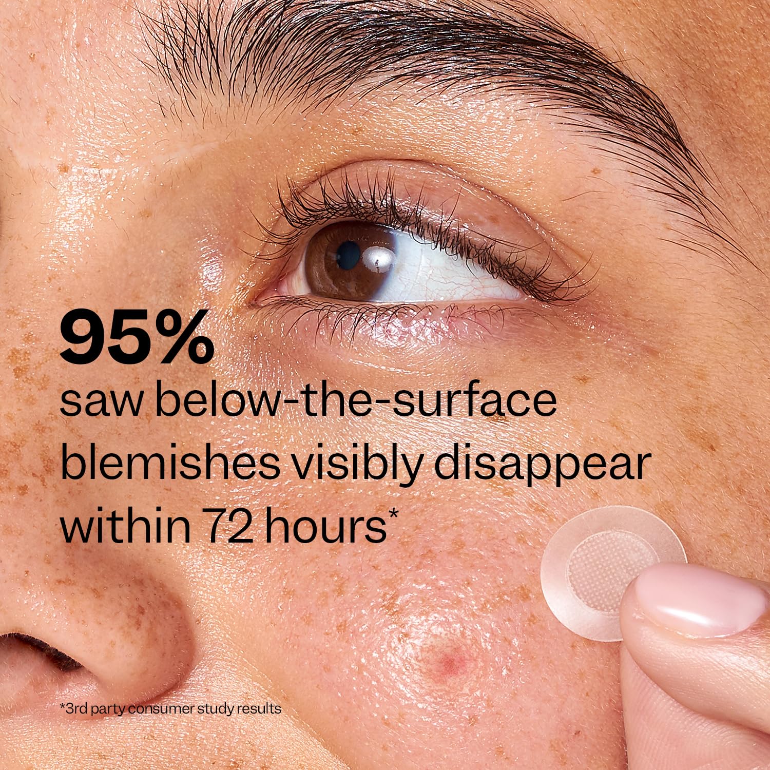 Peach Slices - Deep Blemish Microdarts (9 ct) - Early Stage Pimple Patches for Face - Salicylic Acid, Niacinamide, Hyaluronic Acid, Tea Tree Oil & Cica - Vegan, Cruelty Free, Korean Skin Care & Beauty