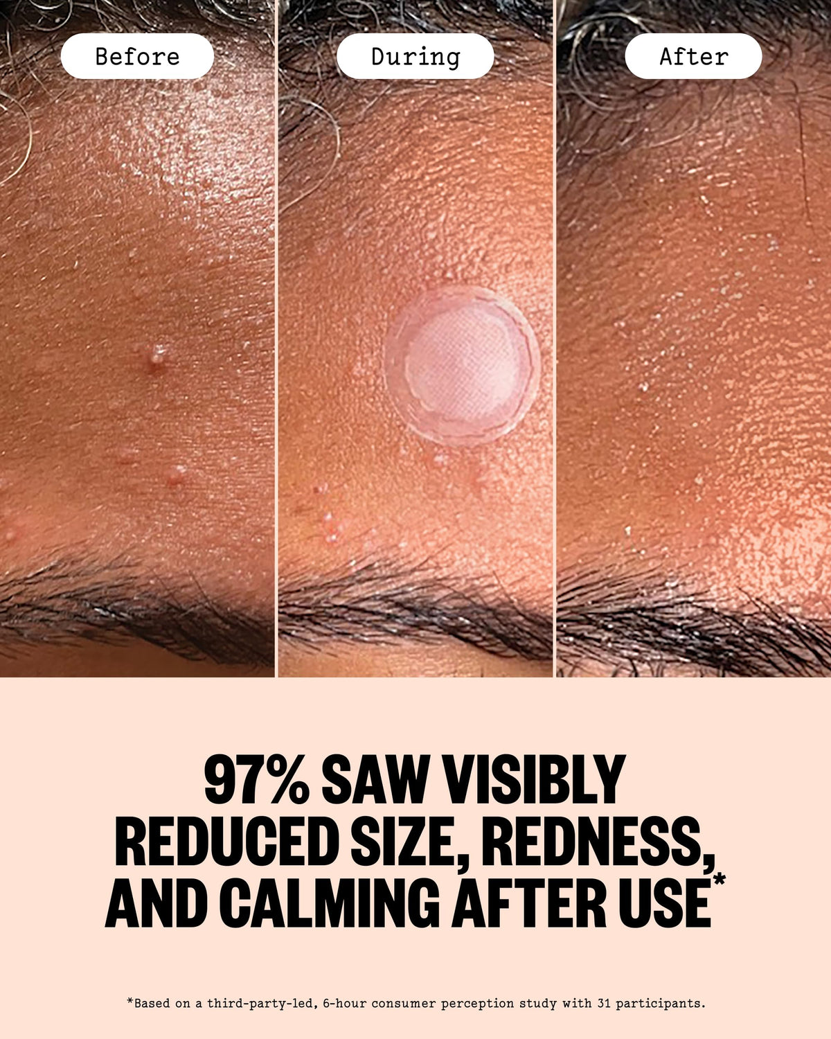 PEACE OUT Early Stage Acne Microneedling Hydrocolloid Dots - PEACE OUT Official Imagery - 5