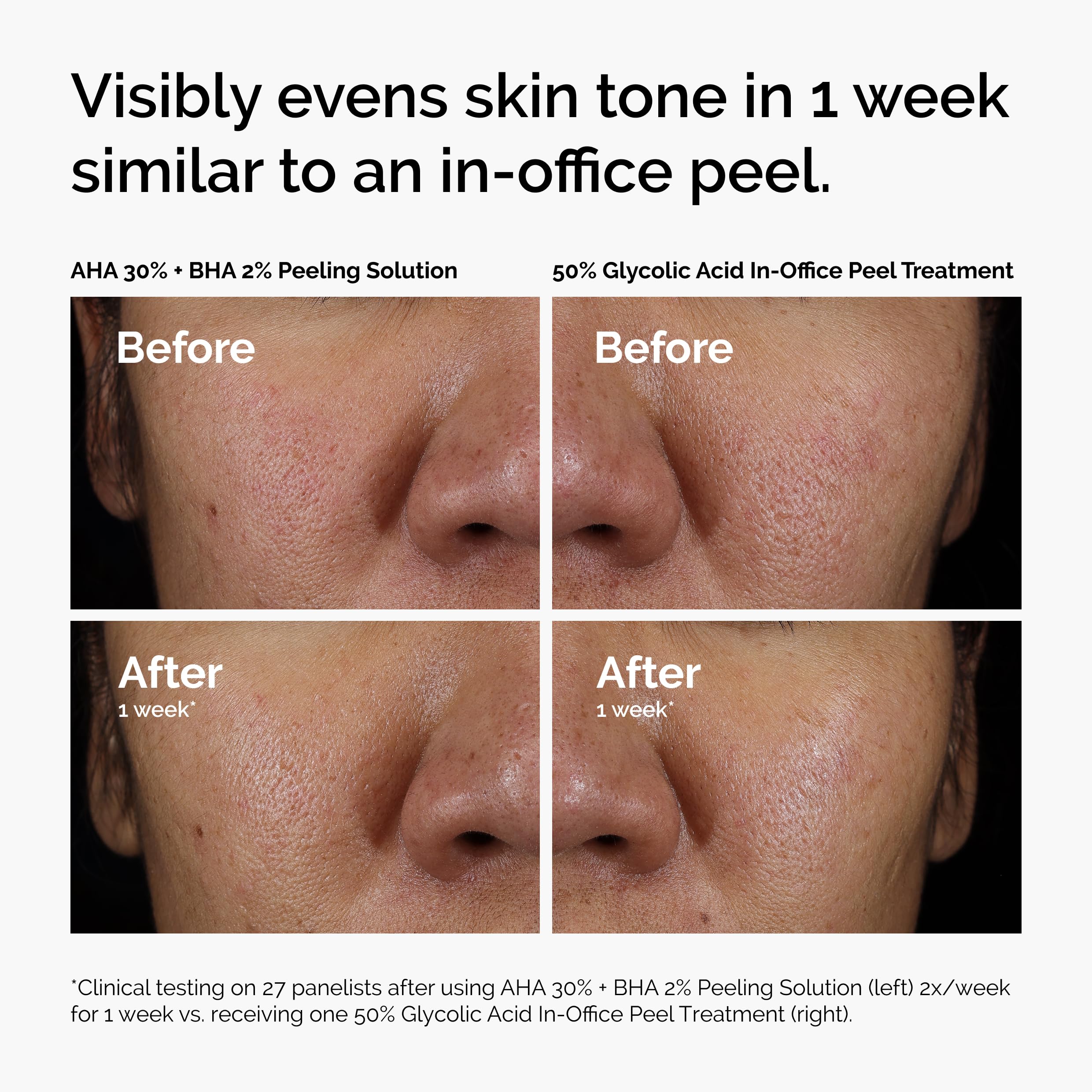 The Ordinary AHA 30% + BHA 2% Peeling Solution, Advanced Exfoliating Peel for Brighter Skin - Elefair Tech Official Product View 8