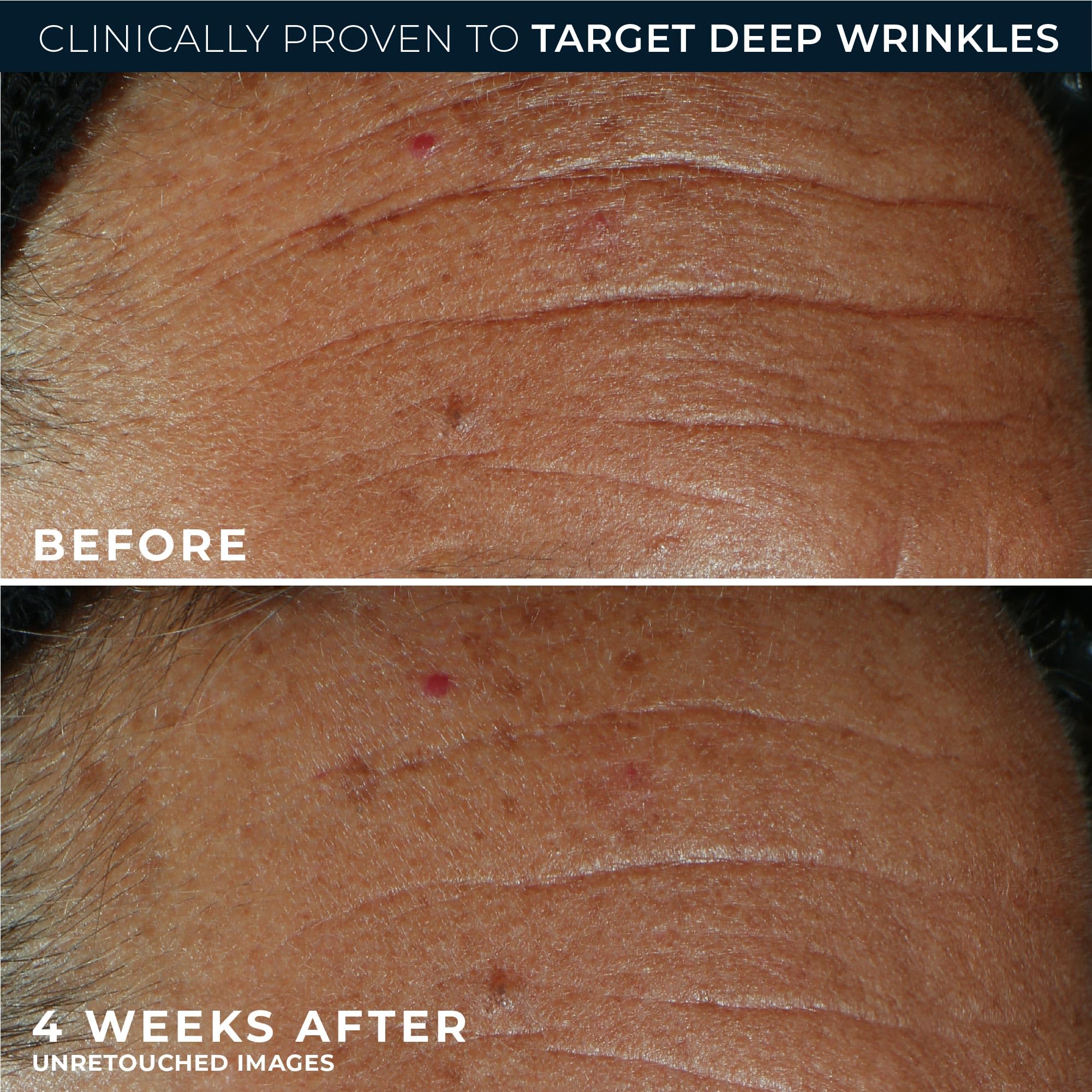 RoC Derm Correxion Fill Treat Retinol Serum Deep Wrinkle - RoC Official Imagery - 7