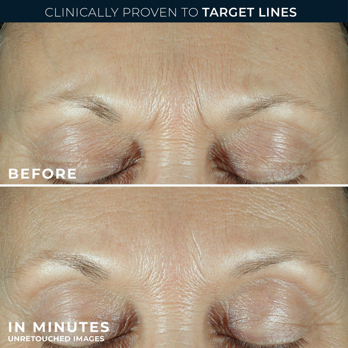 RoC Derm Correxion Fill Treat Retinol Serum Deep Wrinkle - RoC Official Imagery - 6