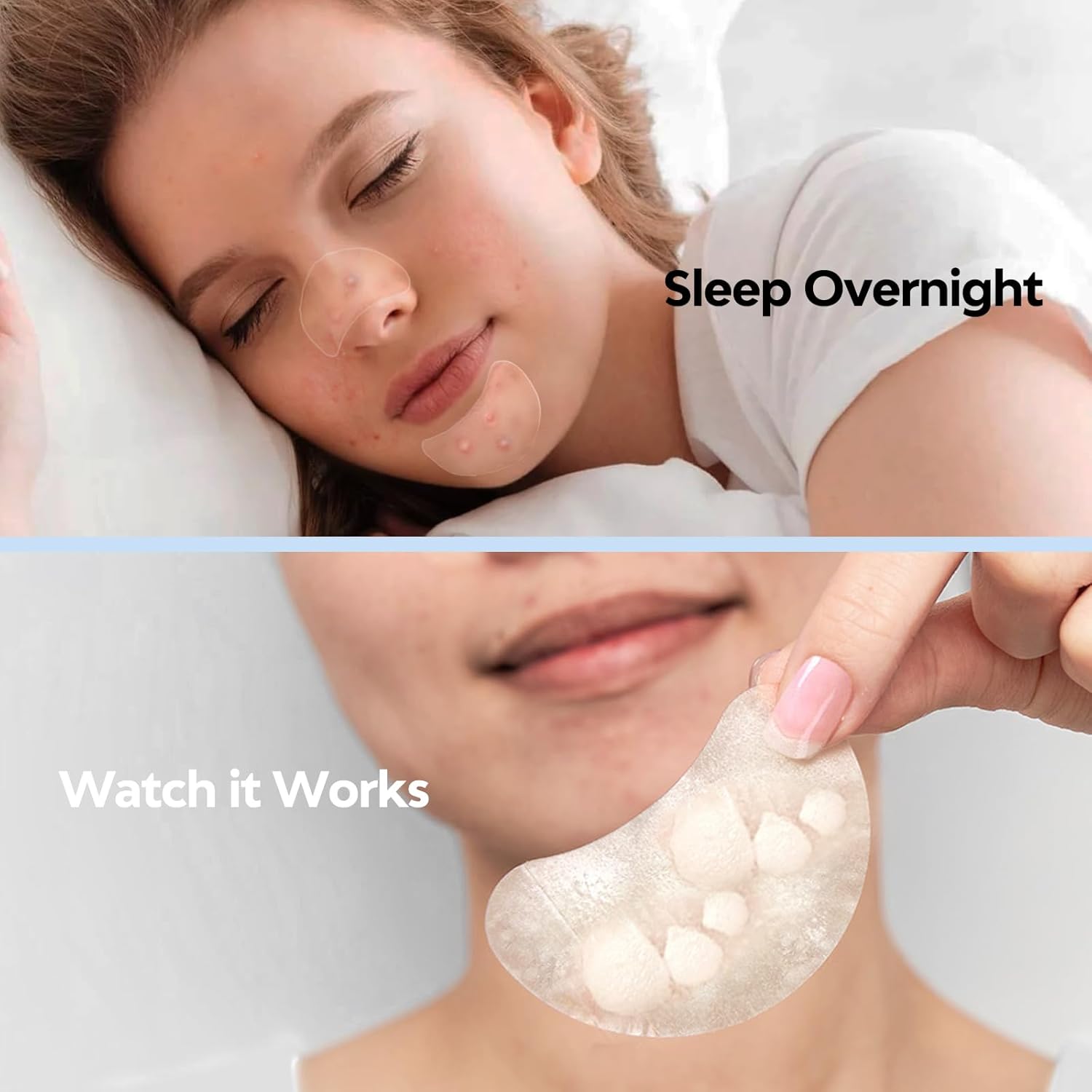 Large Pimple Patches for Face 331 Patches,Hydrocolloid Acne Patchvea
