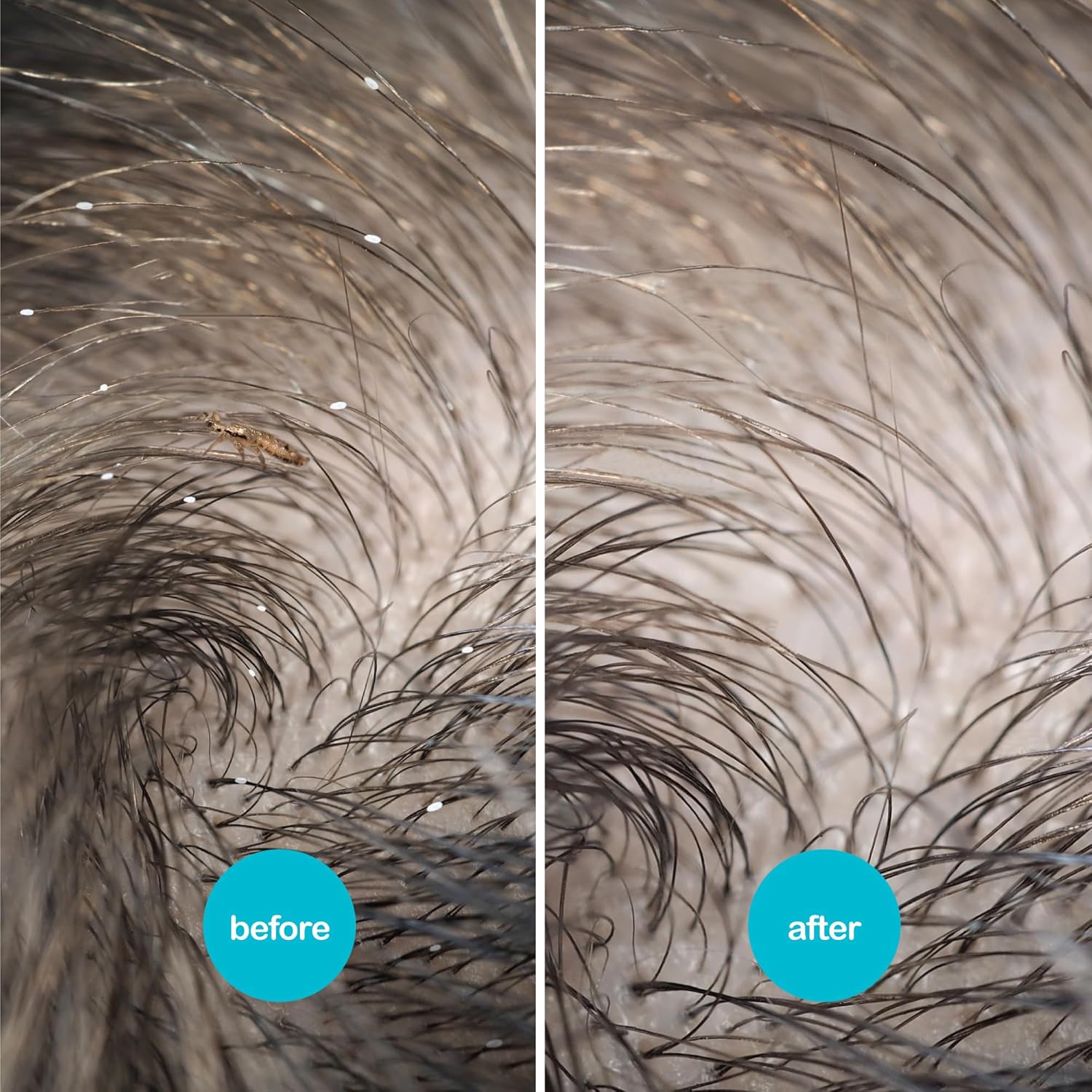 NitWits All-in-One Head Lice Treatment Spray, Kills Lice, Super Lice & Eggs